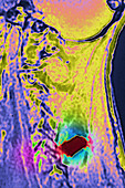 Bullet injury in neck, MRI