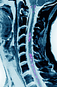 Radiation myelitis, MRI