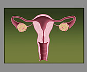Polycystic Ovaries, Illustration