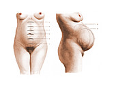 Expanding Uterus, Illustration