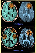 Subacute Sclerosing Panencephalitis