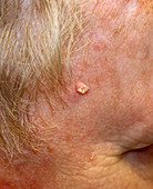 Squamous Cell Carcinoma, Skin Cancer