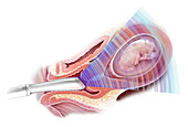 Vaginal Ultrasound