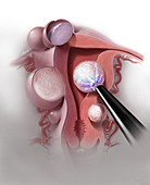 Radiofrequency Ablation of Uterine Fibroids