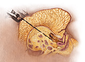 Surgical Considerations with Morbid Obesity