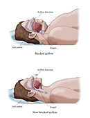 Obesity and Sleep Apnea, Illustration