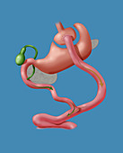 Roux-en-Y Gastric Bypass Surgery, Illustration