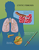 Cystic Fibrosis, Illustration