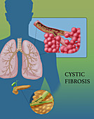 Cystic Fibrosis, Illustration