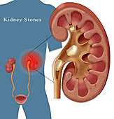 Kidney Stone Pain, Illustration