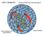 Type 1 Diabetes, Damaged Islets of Langerhans Cells