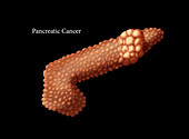 Pancreatic Cancer, Illustration