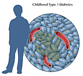 Type 1 Diabetes in Childhood