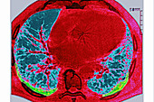 Asbestosis, CT scan