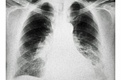 Pulmonary Embolism, X-ray