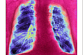 Pulmonary emphysema, X-ray