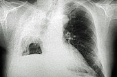 Lung Cancer, X-ray