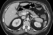 Pancreas, normal x-ray