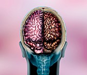 Brain in Alzheimer's disease, illustration