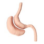 Illustration of a vertical sleeve gastrectomy