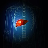 Illustration of liver cancer