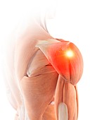 Illustration of shoulder muscle pain