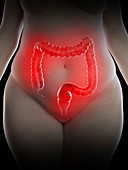 Illustration of an obese woman's inflamed colon
