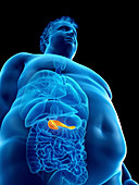 Illustration of an obese man's pancreas