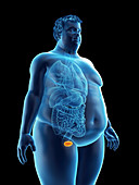 Illustration of an obese man's bladder