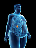 Illustration of an obese man's gallbladder