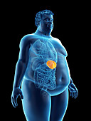 Illustration of an obese man's spleen