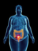 Illustration of an obese man's colon tumor
