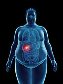 Illustration of an obese man's gallbladder tumor