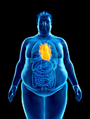 Illustration of an obese man's heart