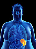 Illustration of an obese man's spleen