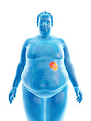 Illustration of an obese man's spleen