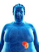 Illustration of an obese man's spleen