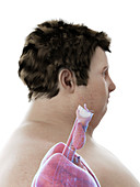 Illustration of an obese man's throat anatomy