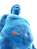 Illustration of an obese man's pancreas