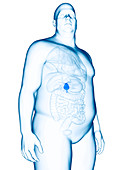 Illustration of an obese man's gallbladder