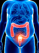 Illustration of an obese man with a painful colon