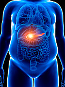 Illustration of an obese man with a painful pancreas