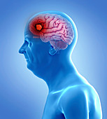 Illustration of a brain tumor