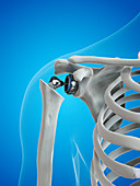 Illustration of a shoulder replacement