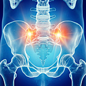 Illustration of a painful sacrum joint