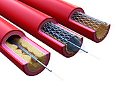 Illustration of a stent being placed