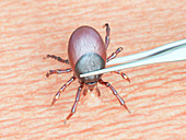 Illustration of a tick being removed
