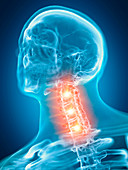 Illustration of a painful cervical spine