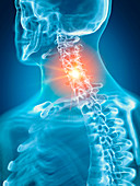 Illustration of a painful cervical spine