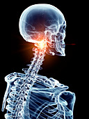 Illustration of a painful cervical spine